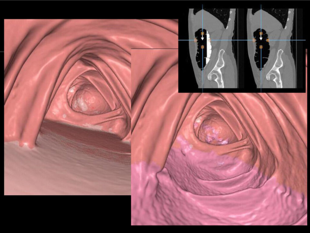 virtualna kolonoskopija