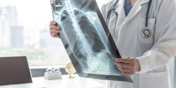 Od ove kronične bolesti pluća obolijevaju mnogi: Evo kako je prepoznati